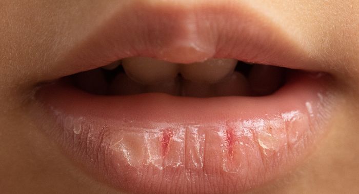 What Are The Reasons For Chapped Lips?